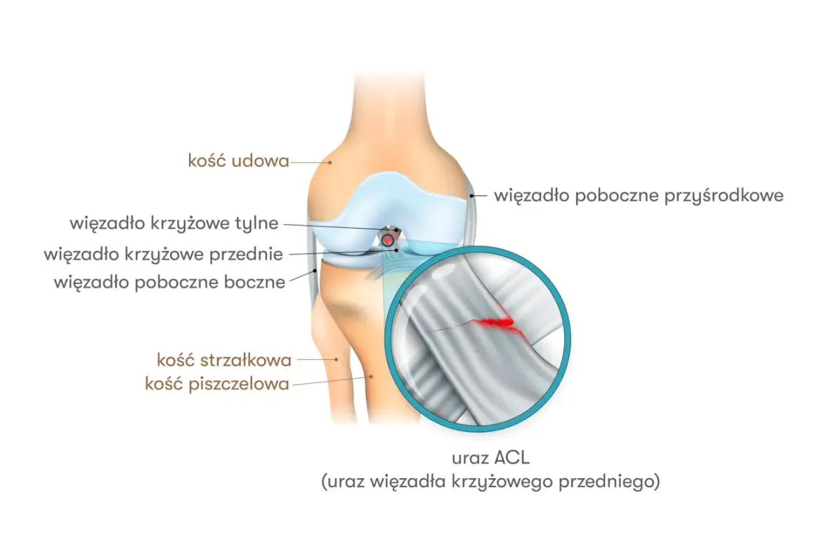 Anatomia kolana z zaznaczonym urazem ACL (przedniego więzadła krzyżowego). Widoczne kości i więzadła.