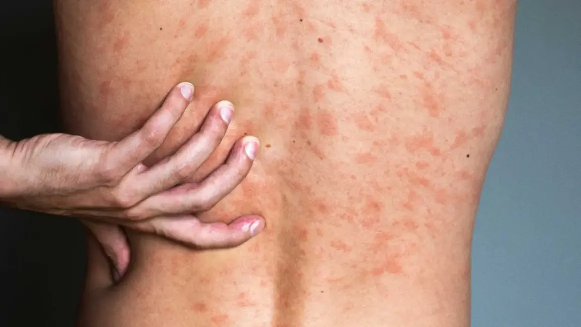 Une main gratte le dos couvert de plaques rouges, signe d'urticaire après la douche.