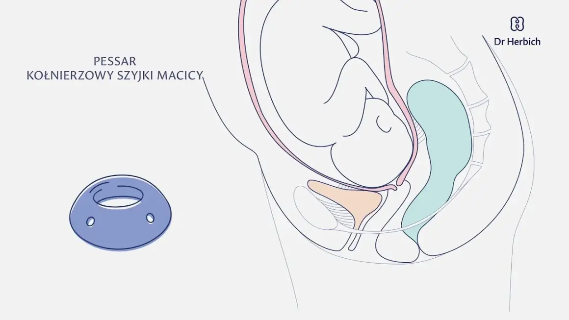 Skracanie szyjki macicy w ciąży: Jak zapobiec przedwczesnemu porodowi?