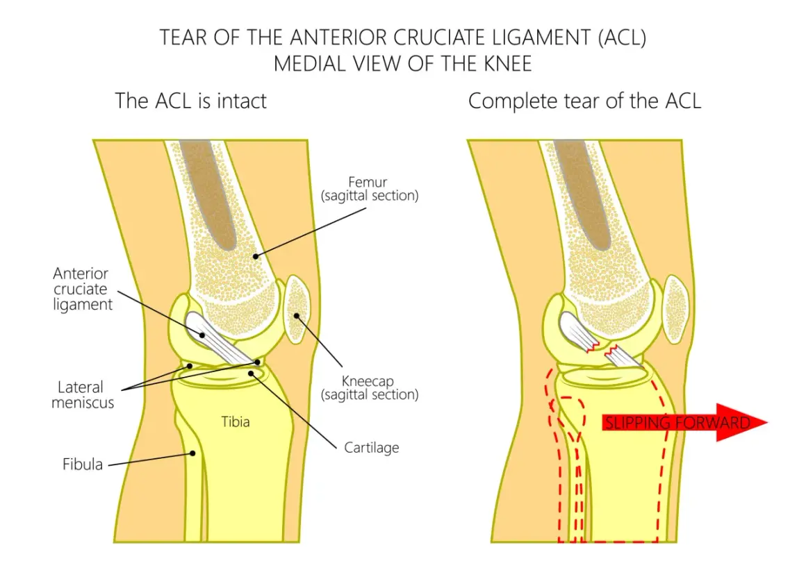 Anatomia kolana: zerwane więzadło krzyżowe przednie (ACL) powoduje przesuwanie się kości. Ltc kolano co to jest – ilustracja pokazuje uszkodzenie ACL.