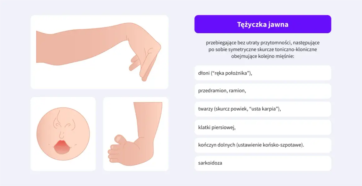 Ilustracja pokazuje tężyczkę jawną, objawy obejmują dłoń jak u położnika, skurcze twarzy i kończyn.
