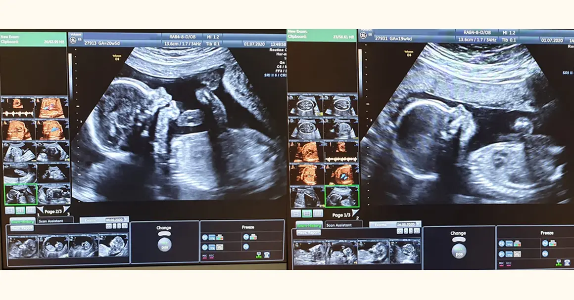 Badania prenatalne w 12 tyg. ciąży: USG genetyczne i PAPP-A bez obaw