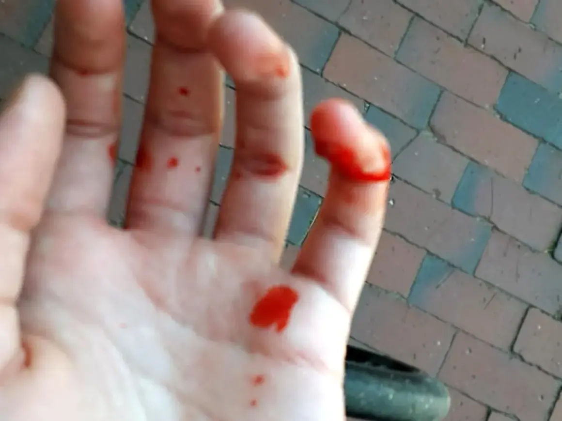 Blutige Hand mit einem offensichtlich gebrochenen Finger. Kleine Schnitte und Blutstropfen auf der Handfläche und den Fingern.