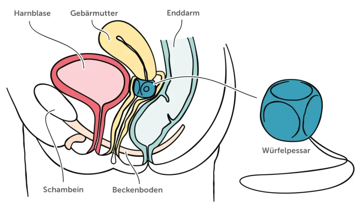 Schema des weiblichen Beckens mit Harnblase, Gebärmutter und Enddarm. Ein Würfelpessar wird gezeigt, dessen Nachteile hier nicht thematisiert werden.