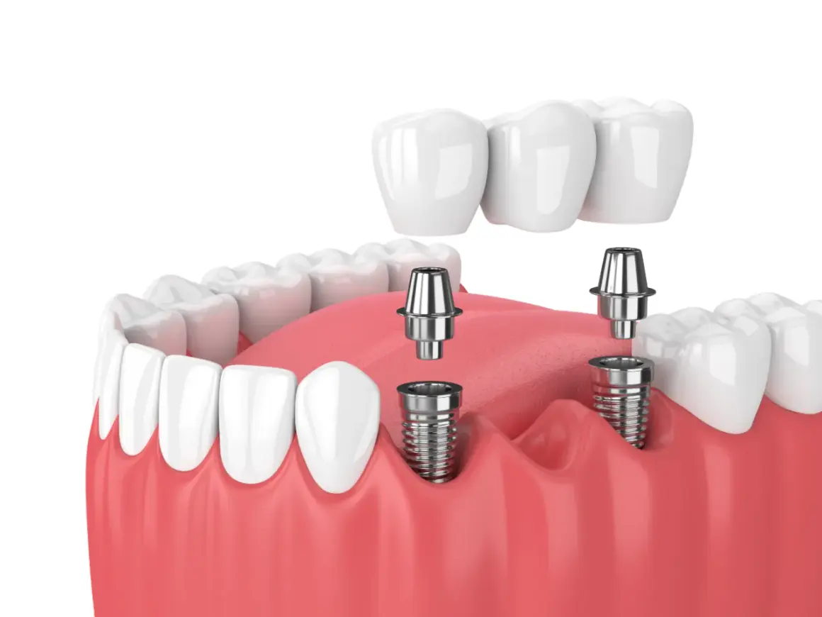 Model szczęki z widocznymi implantami zębowymi i mostem protetycznym. Implant zęba to nowoczesne rozwiązanie.