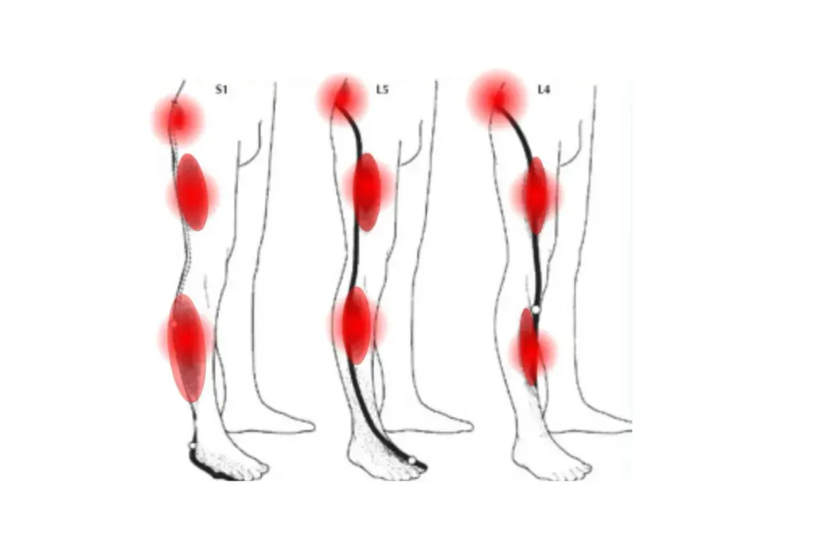 Schéma montrant les zones de douleur du nerf sciatique, incluant le mollet, avec des points rouges indiquant l'inflammation.