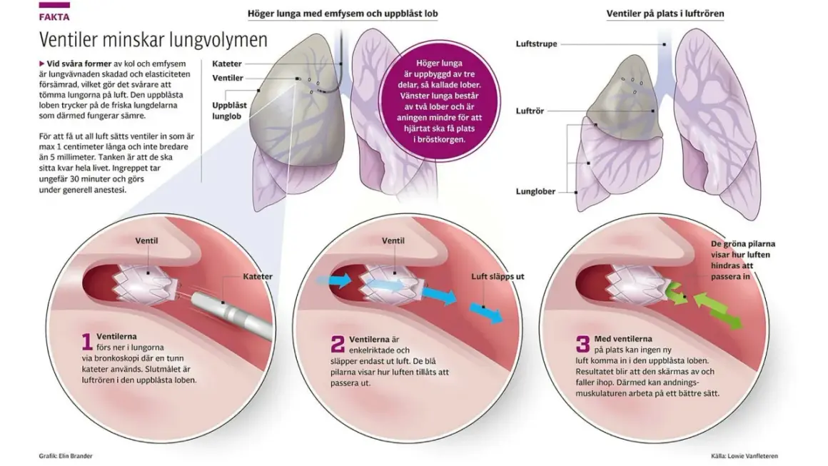 Illustration som visar hur ventiler placeras i lungan för att behandla emfysem. Ventiler förhindrar luft att komma in i en uppblåst lunglob.