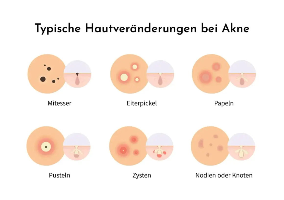 Illustration zeigt typische Hautveränderungen bei Akne: Mitesser, Eiterpickel, Papeln, Pusteln, Zysten und Knoten.