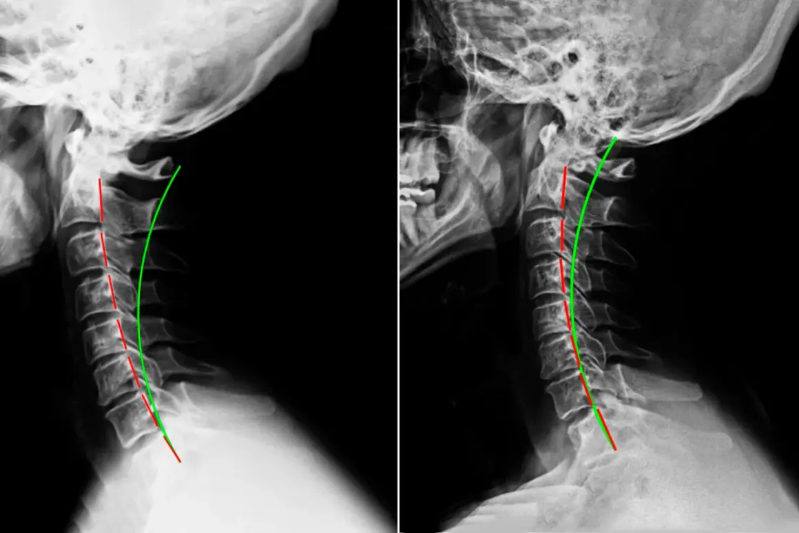 Radiografie cervicali che mostrano una lordosi cervicale ridotta, potenziale causa di vertigini.