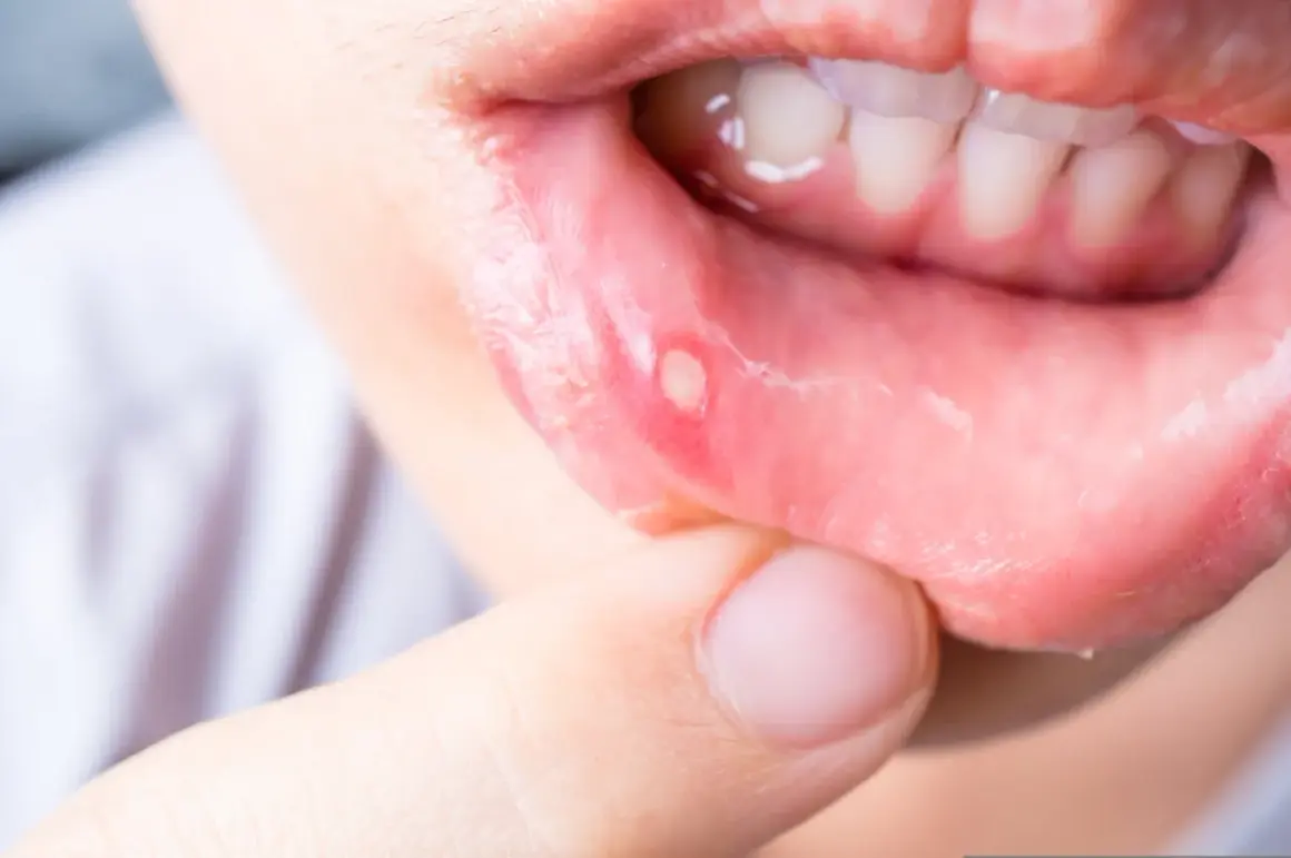 Úlcera bucal, posiblemente herpes, mostrando la necesidad de tratamiento.