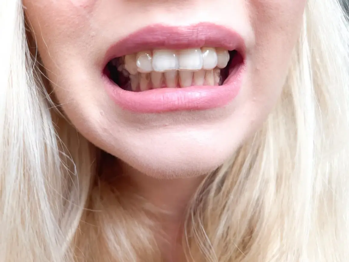 Uśmiech z dyskretnymi nakładkami Invisalign, które korygują zęby. Jasne włosy i różowe usta dopełniają całość.