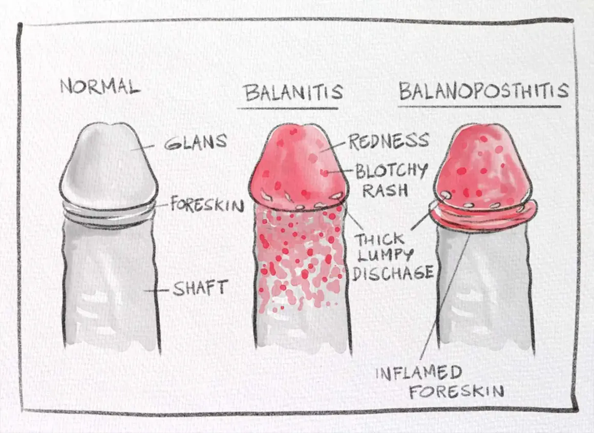 Ilustracja porównuje normalnego penisa z balanitis i balanoposthitis, pokazując objawy takie jak zaczerwienienie i wydzielina. Zrozumienie, smegma co to, jest kluczowe dla higieny.