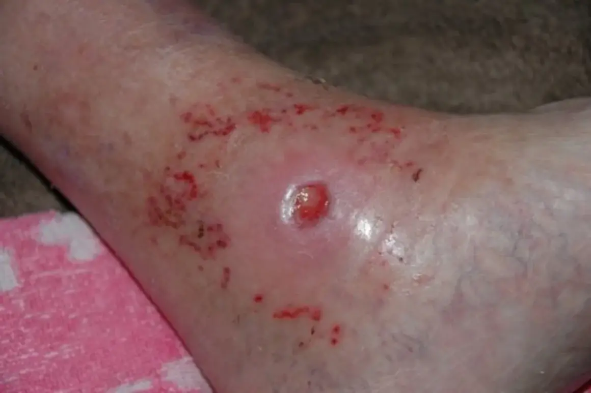 Hautirritation mit Rötung und kleinen Wunden, möglicherweise eine panthenol allergie.