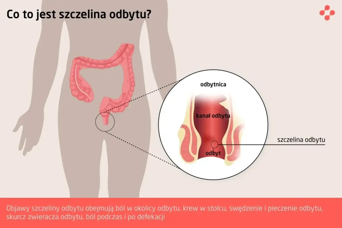 Ilustracja przedstawia anatomię odbytu z zaznaczoną szczeliną. Objawy szczeliny odbytu to ból, krwawienie i pieczenie.