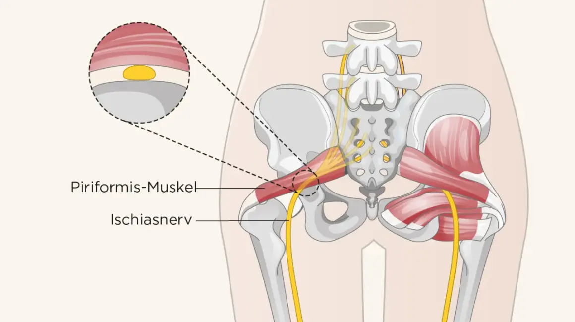 Der musculus piriformis im Beckenbereich, daneben der Ischiasnerv. Eine Nahaufnahme zeigt die Muskelfaserstruktur.