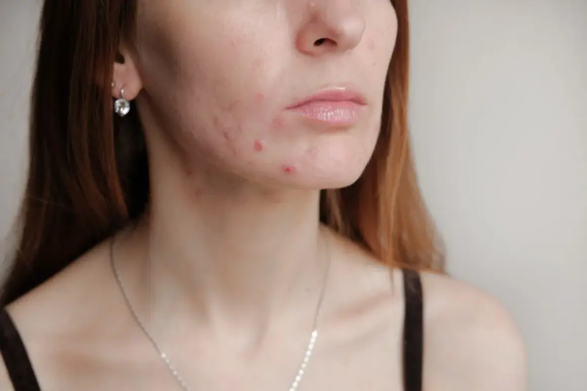 Hautunreinheiten im Gesicht und am Hals, möglicherweise nach dem Absetzen der Pille. Rote Pickel und Mitesser sind sichtbar.