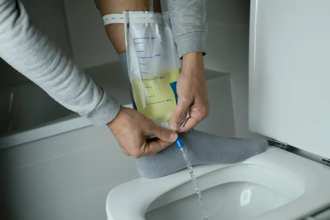 Mann entleert Urinbeutel, der mit einem Bauchdeckenkatheter verbunden ist. Erfahrungen damit sind oft eine Umstellung.