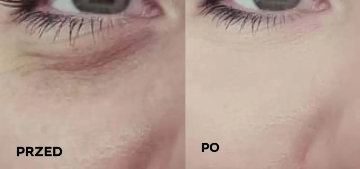 Przed i po: jak dbać o skórę pod oczami, by była gładka i wypoczęta. Widoczne wygładzenie zmarszczek.