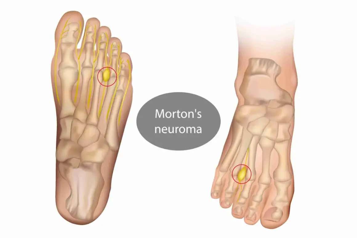 Illustrazione anatomica del piede che mostra un neuroma di Morton, una condizione che rende doloroso il camminare.