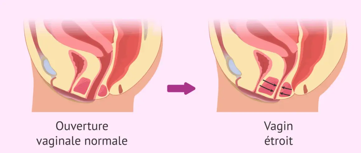 Illustration anatomique montrant une ouverture vaginale normale puis un vagin étroit suite à une contraction involontaire du périnée.
