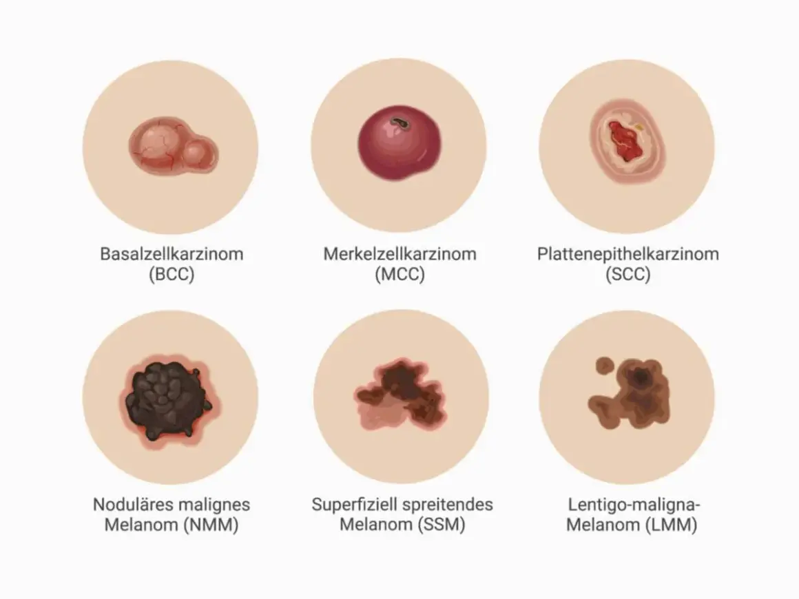 Sechs Hautveränderungen: Basalzellkarzinom, Merkelzellkarzinom, Plattenepithelkarzinom, noduläres malignes Melanom, superfiziell spreitendes Melanom und Lentigo-maligna-Melanom. So können Sie ein Merkelzellkarzinom erkennen.