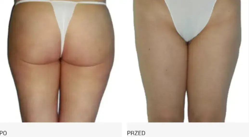 Endermologia: Jak często? Odstępy (2-3x/tydz.) dla trwałych efektów