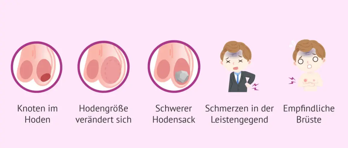 Illustration zeigt einen Hoden mit einem Knubbel, veränderte Hodengröße, einen schweren Hodensack, Schmerzen in der Leistengegend und empfindliche Brüste.