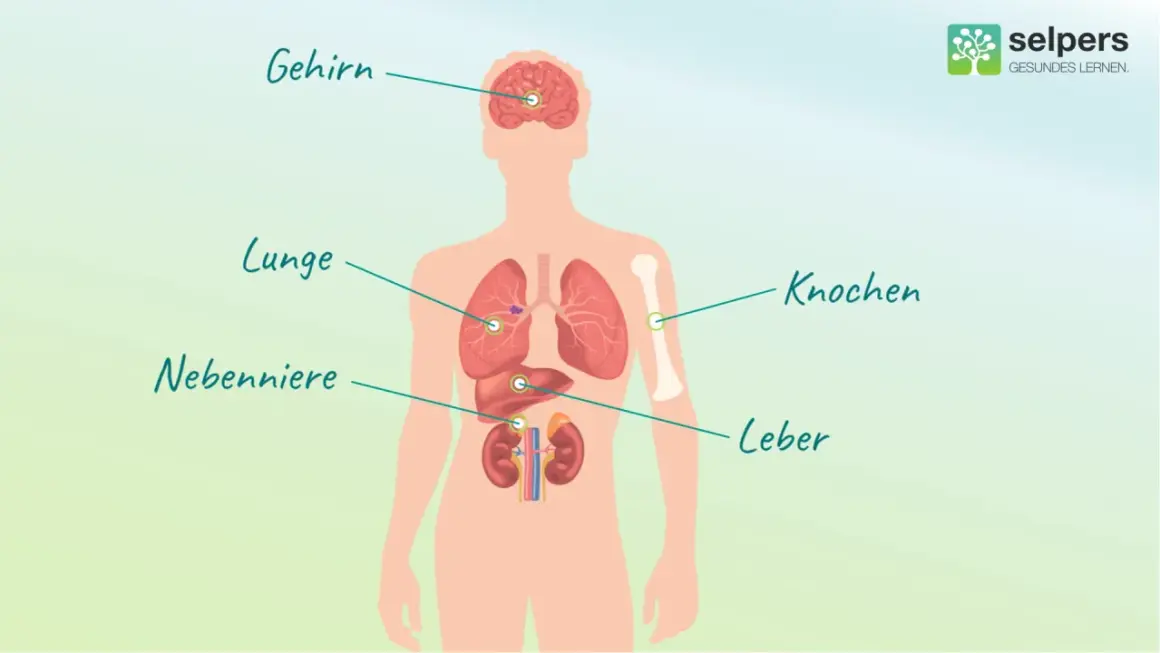 Illustration zeigt menschlichen Körper mit markierten Organen: Gehirn, Lunge, Nebenniere, Knochen, Leber. Mögliche Metastasierungsorte bei Lungenkrebs.