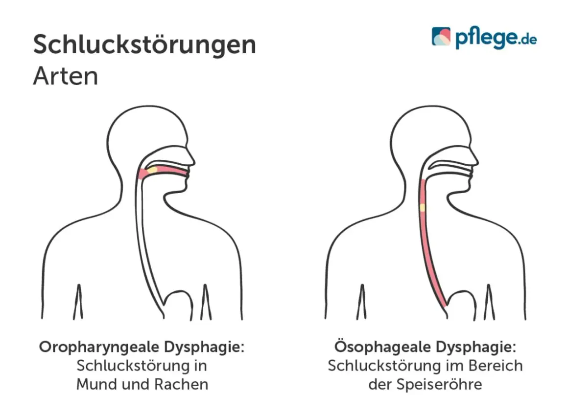 Illustrationen zeigen zwei Arten von Dysphagie: Oropharyngeale Dysphagie (Mund/Rachen) und Ösophageale Dysphagie (Speiseröhre).