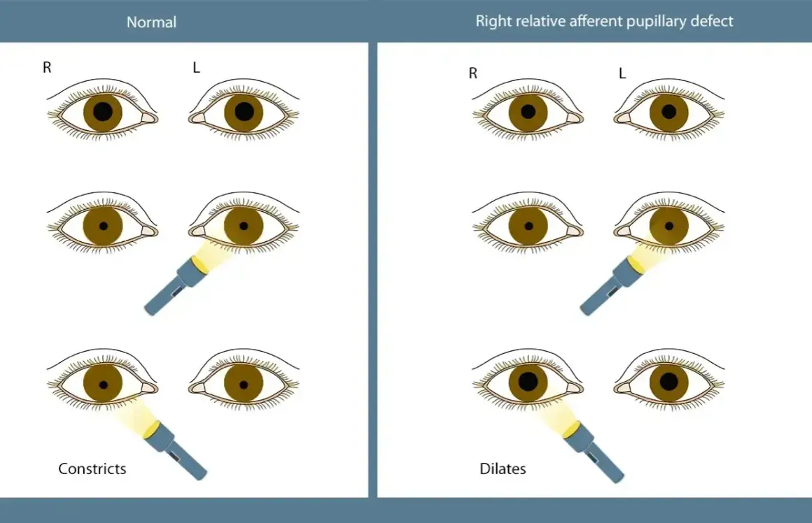 Ilustracja porównuje reakcję źrenic w oku normalnym i z prawostronnym deficytem aferentnym. Widoczna anizokoria, czyli nierówność źrenic, jest kluczowa w diagnostyce.