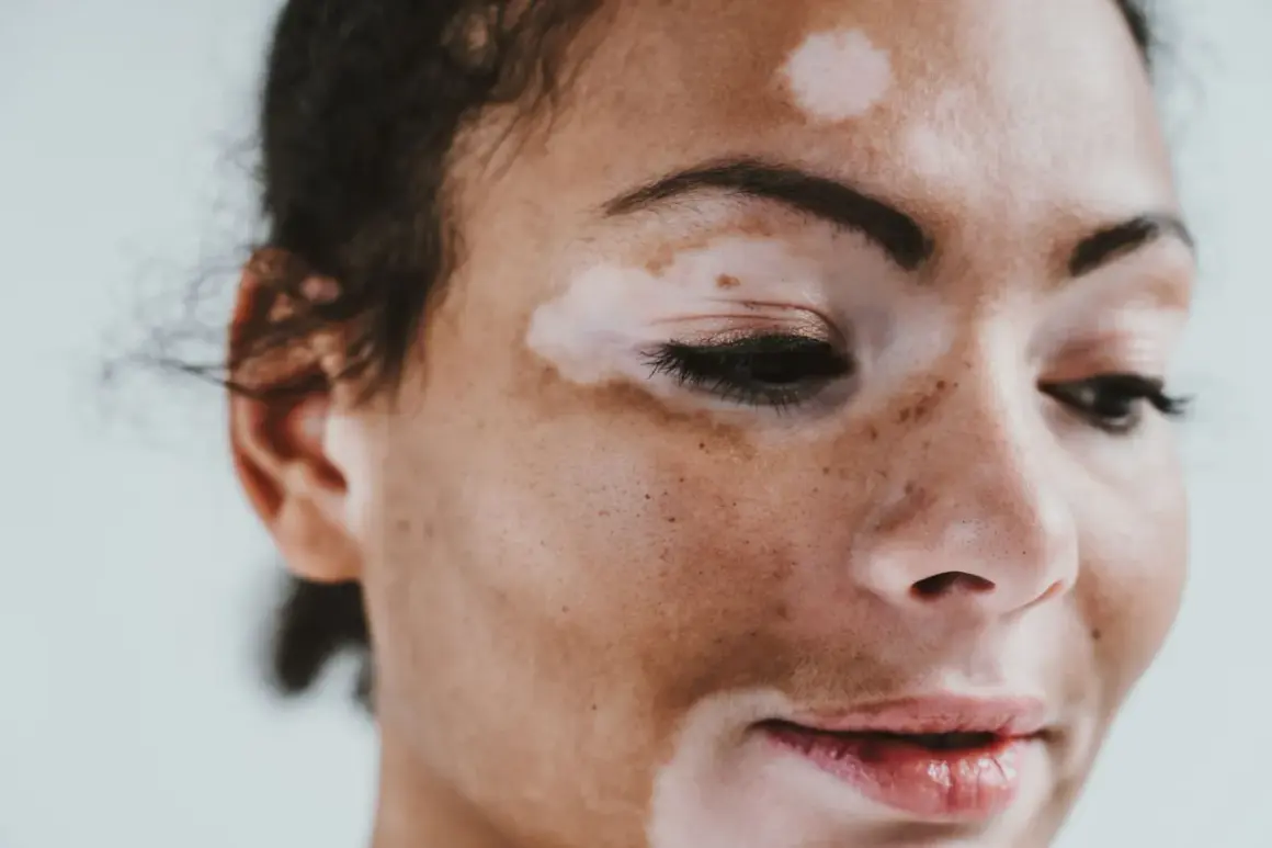 Portret kobiety z widocznym **vitiligo** na twarzy. Jasne plamy kontrastują z jej ciemniejszą skórą, tworząc unikalny wzór.