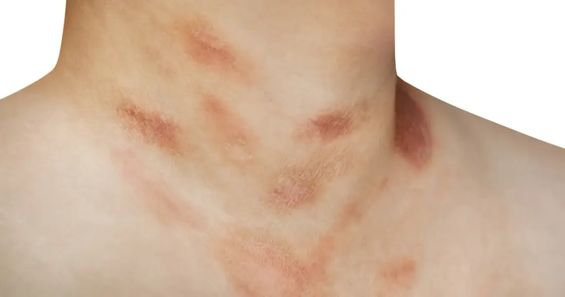 Hautirritationen am Hals, die wie ein pilzartiger Ausschlag aussehen, mit roten, schuppigen Flecken.