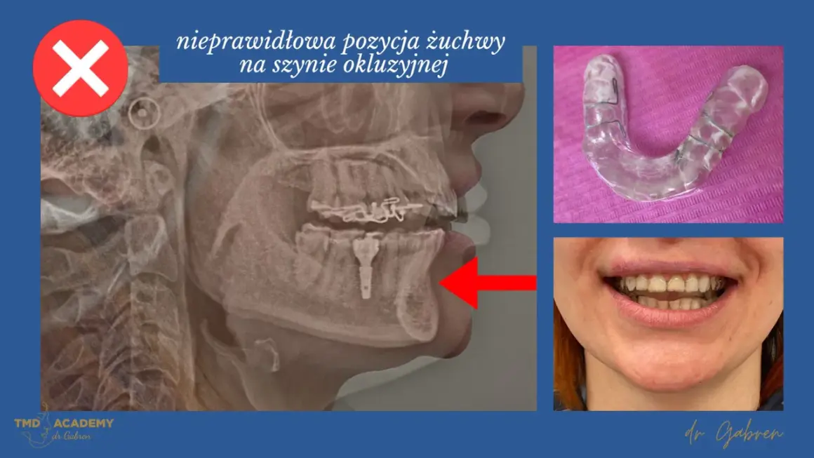 Rentgen żuchwy z nieprawidłową pozycją, szyna relaksacyjna twarda. Czerwony X oznacza błąd.