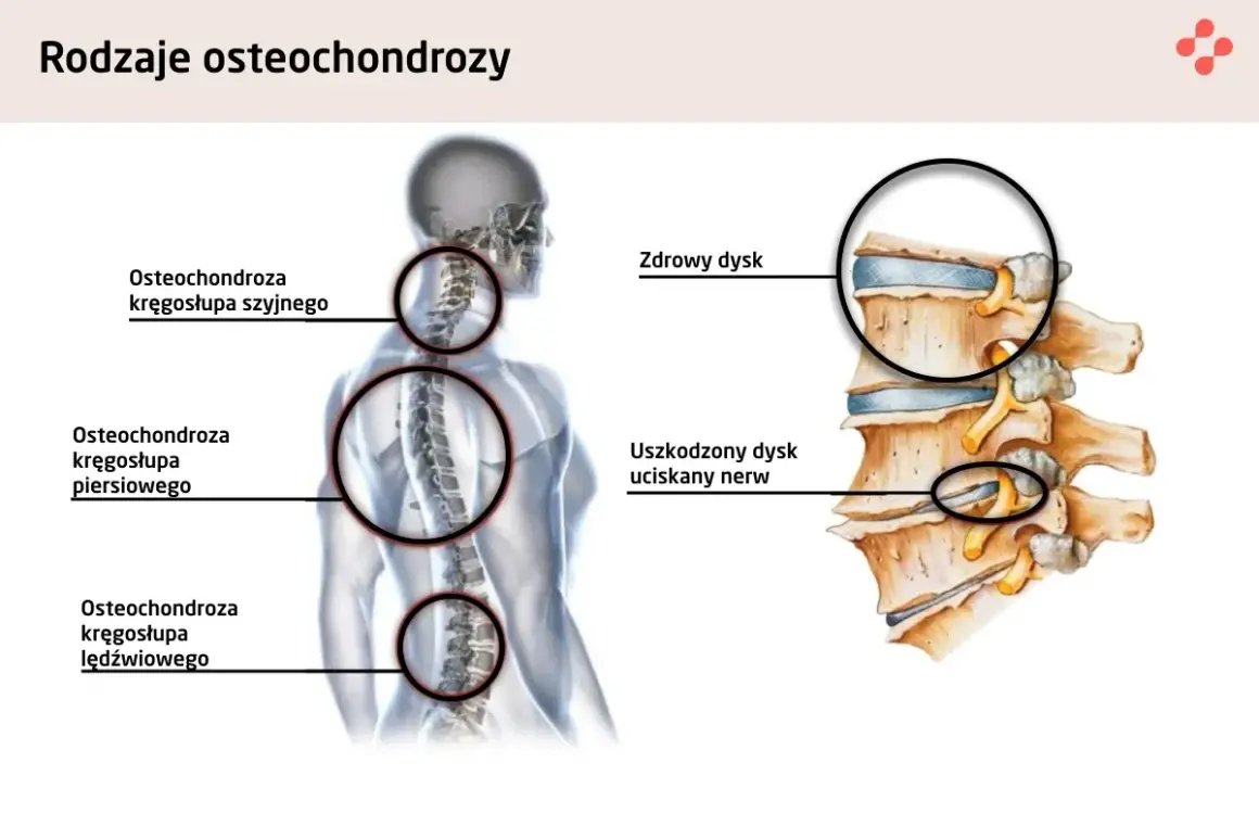 Ilustracja pokazuje ucisk na nerw szyjny objawy. Widoczna osteochondroza kręgosłupa szyjnego, piersiowego i lędźwiowego.