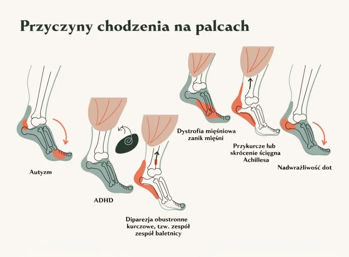 Ilustracja pokazuje, jak 10-letnie dziecko chodzi na palcach z powodu autyzmu, ADHD, dystrofii mięśniowej, przykurczu ścięgna Achillesa lub nadwrażliwości dotykowej.