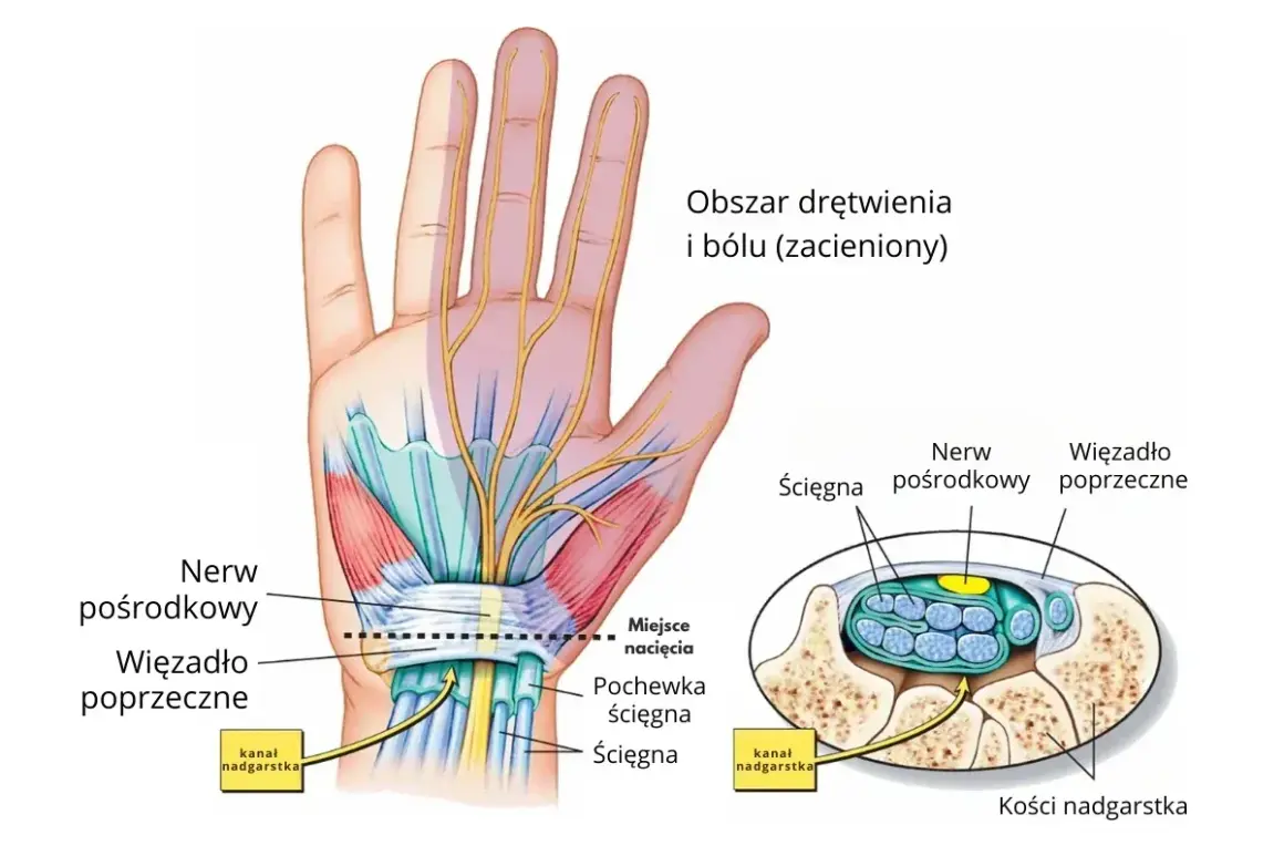 Anatomia dłoni i nadgarstka, pokazująca nerw pośrodkowy i ścięgna w kanale nadgarstka, obszar drętwienia i bólu.