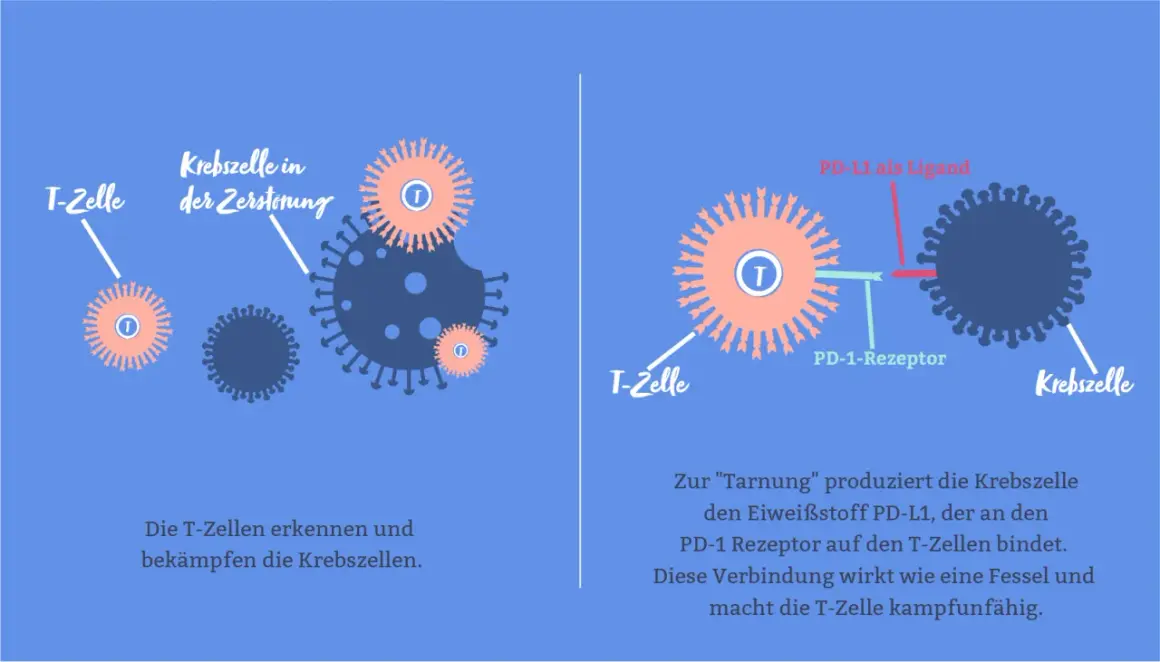 Immuntherapie bei Brustkrebs: T-Zellen bekämpfen Krebszellen, die sich durch PD-L1 tarnen.