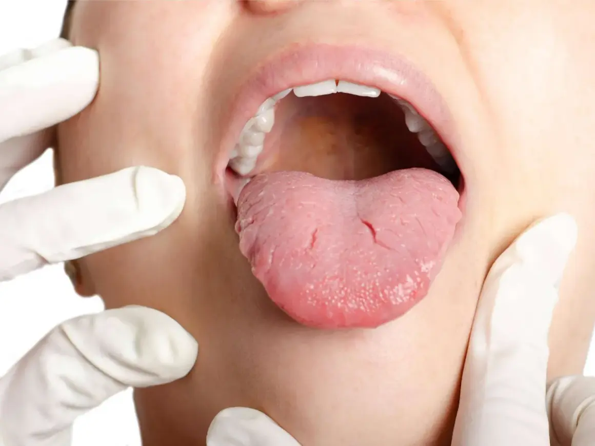 Arzt untersucht Zunge auf mögliche zungenkrebs symptome. Die Zunge ist herausgestreckt, die Lippen geöffnet.