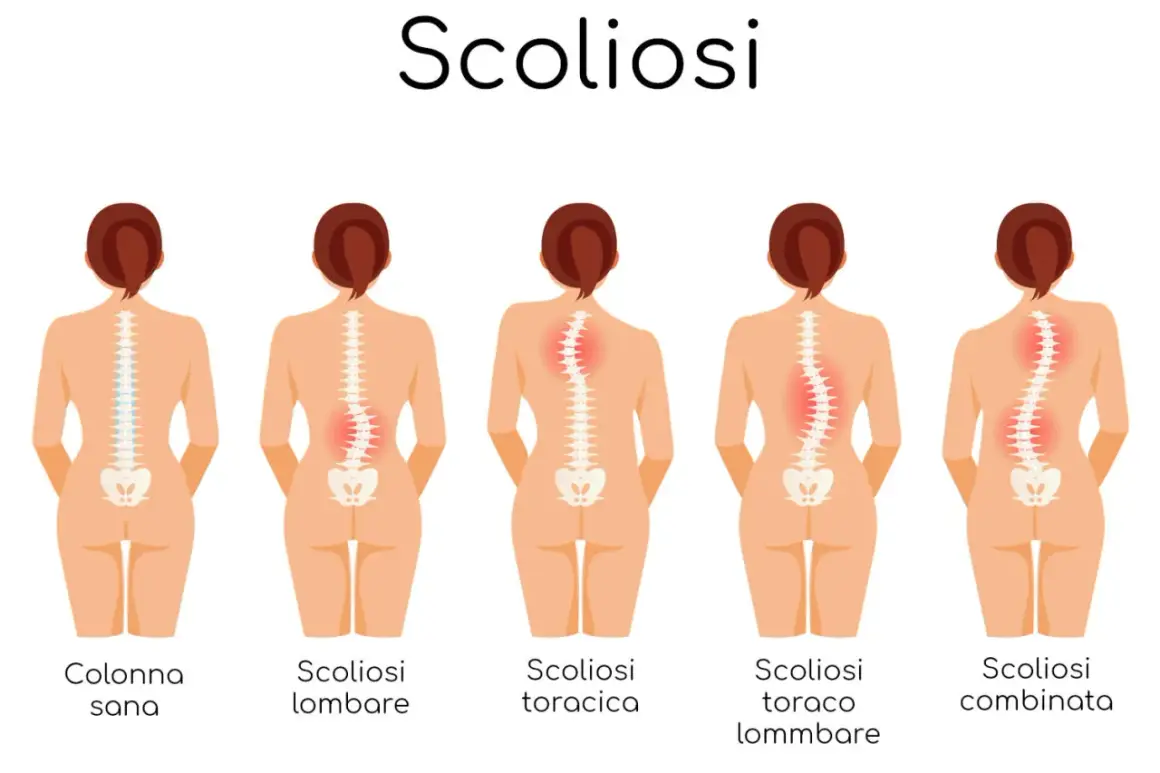 Illustrazione dei diversi tipi di scoliosi e dei relativi sintomi: colonna sana, scoliosi lombare, toracica, toraco-lombare e combinata.