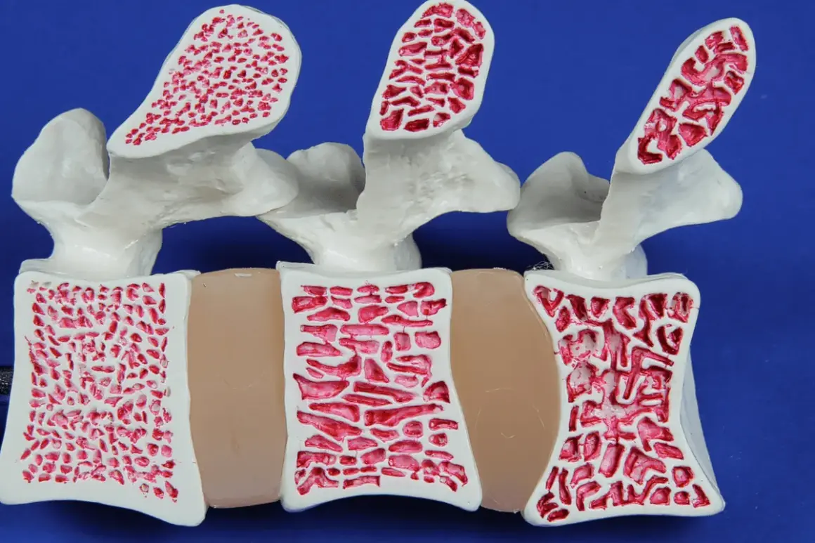 Model kręgosłupa z widoczną strukturą kości. Po lewej kość zdrowa, po prawej widoczne ubytki świadczące o osteoporozie.