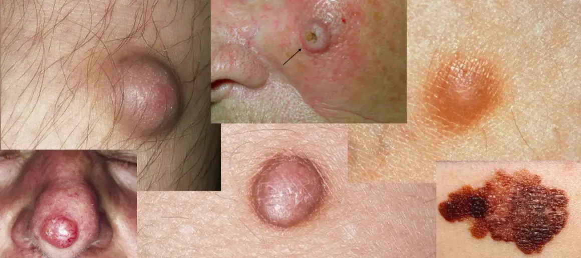 Hautveränderungen: Beulen, rote Flecken und dunkle Muttermale zeigen, wie schaut hautkrebs aus.