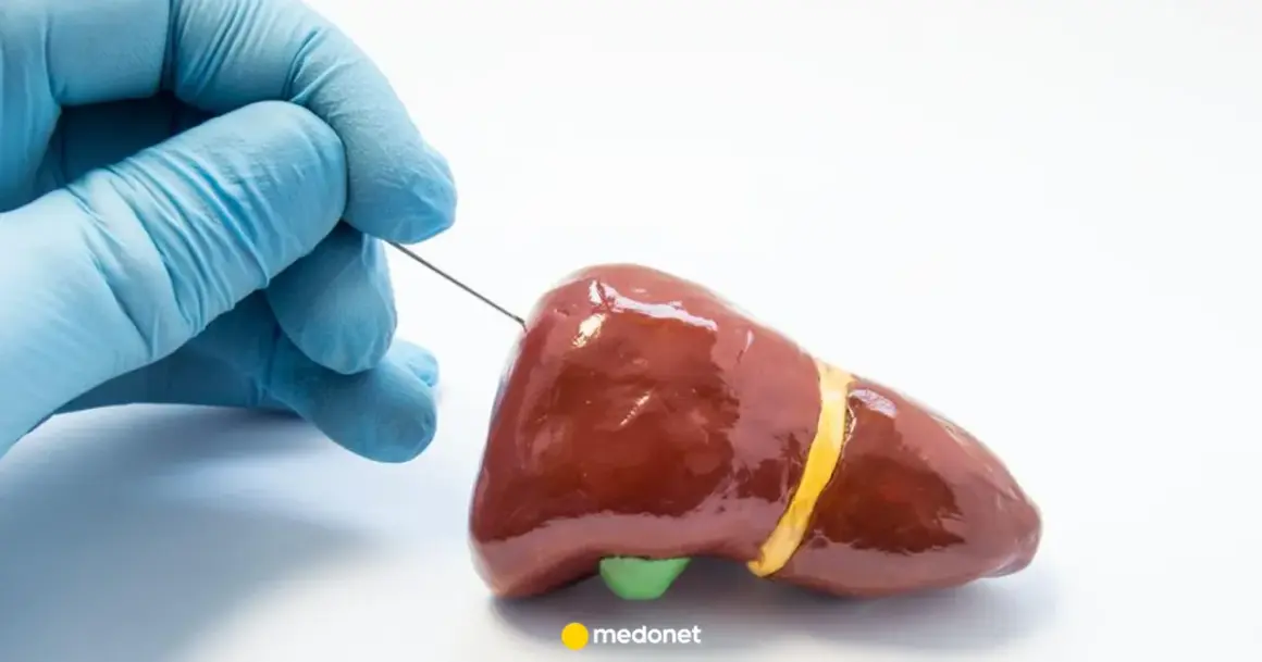 Rękawiczka w niebieskiej rękawiczce delikatnie wprowadza biopsja gruboigłowa igła do modelu wątroby.