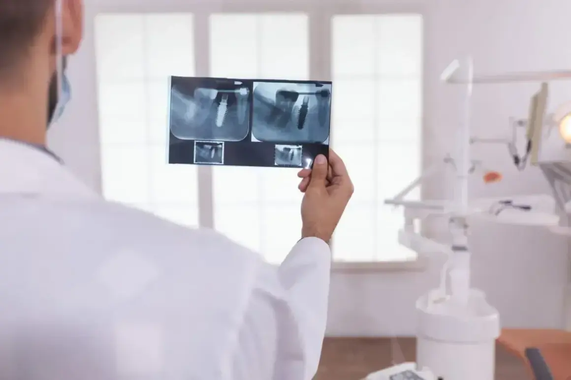 Dentysta analizuje RTG zęba z implantem. Zastanawia się, ile kanałów ma 6.