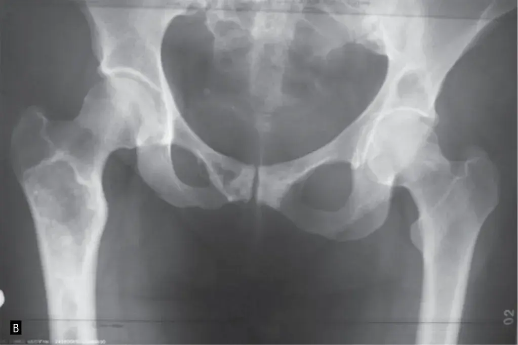Czym jest ognisko osteolityczne? Przyczyny, objawy i diagnostyka zmian w kościach