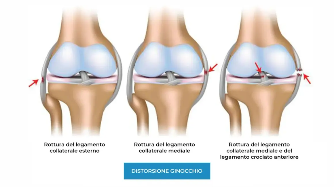 Illustrazione di ginocchia con lesioni ai legamenti: rottura collaterale esterno, mediale e combinata. Il dolore ai legamenti del ginocchio può variare.