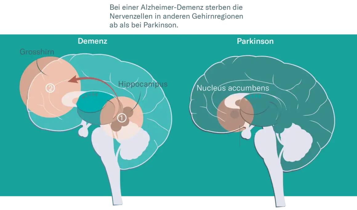 Gehirnschnitt zeigt Unterschiede bei Demenz und Parkinson. Bei Alzheimer-Demenz sterben Nervenzellen im Grosshirn und Hippocampus ab.