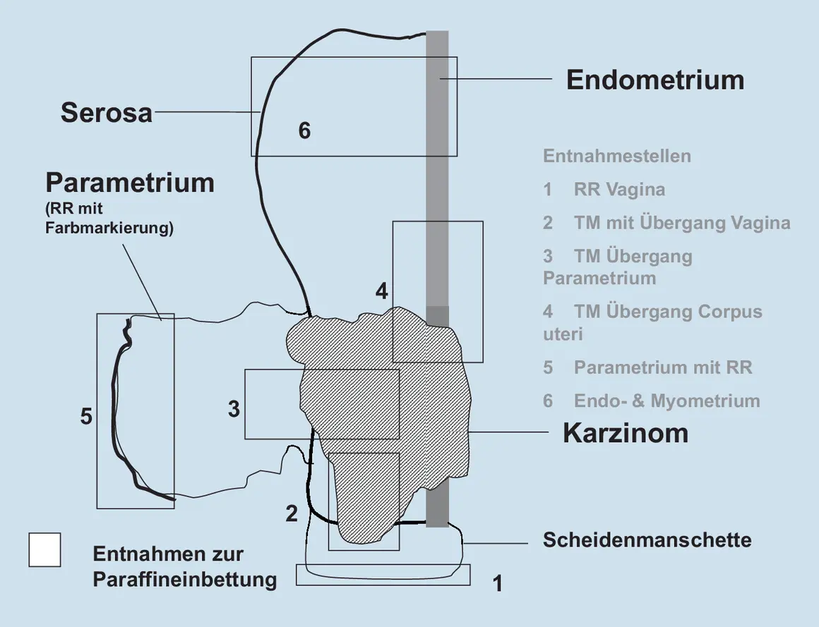 Schema zur Entnahme von Gewebeproben bei Zervixkarzinom. Markiert sind Serosa, Parametrium, Endometrium und Entnahmestellen.