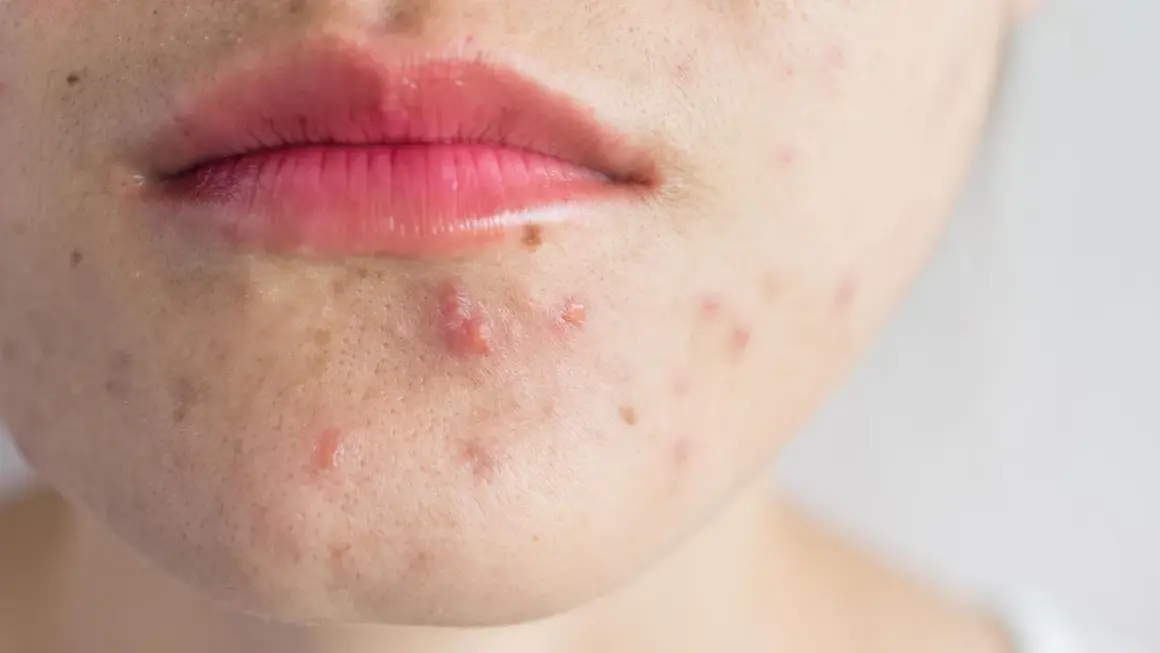 Nahaufnahme von Lippen und Kinn mit fettiger Haut und Pickeln.