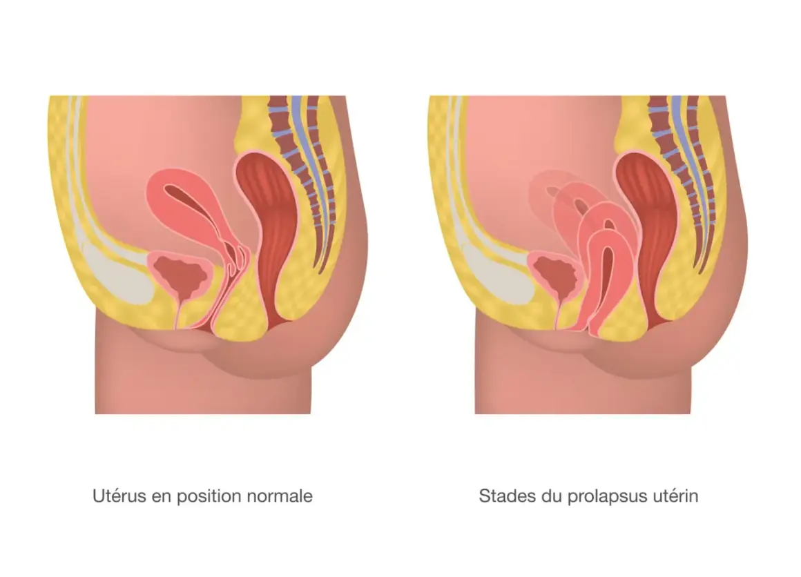 Comparaison d'un utérus en position normale et d'un prolapsus utérin stade 4, où l'organe descend significativement.