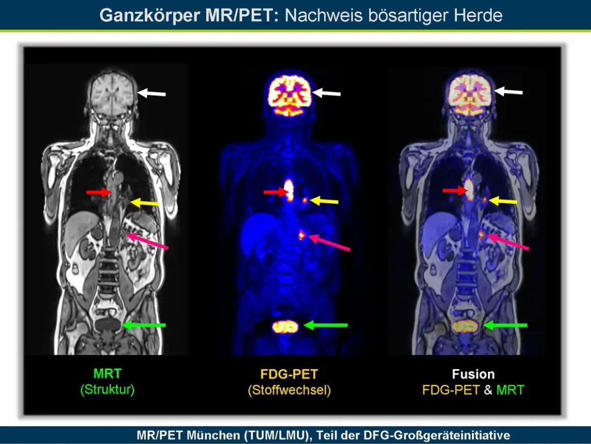 Ganzkörper-PET-CT-Bilder zeigen bösartige Herde. Pfeile markieren Auffälligkeiten in Gehirn, Brustkorb und Becken.